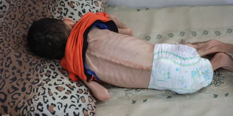 الجوع يفتك بأرواح الأبرياء.. 5 شهداء جدد بينهم طفلان في غزة