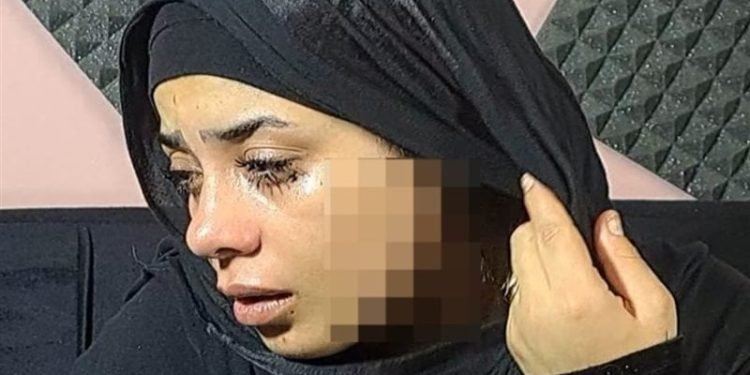 “41 غرزة في الوجه”.. تفاصيل تعدي سيدة على خطيبة طليقها بـ”الموس”