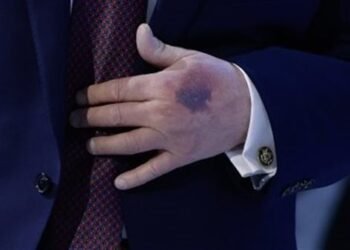 كدمة على يد ترامب تثير تساؤلات حول حالته الصحية.. والبيت الأبيض يكشف السبب