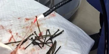 استخراج 100 مسمار وصامولة من معدة مريض بالمنظار في بني سويف