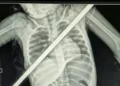 سيخ حديدي يعبر صدر طفلة من اليمين إلى اليسار.. والأطباء ينجحون في إنقاذها