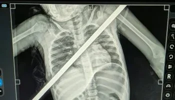 سيخ حديدي يعبر صدر طفلة من اليمين إلى اليسار.. والأطباء ينجحون في إنقاذها