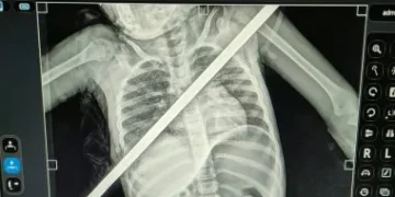 سيخ حديدي يعبر صدر طفلة من اليمين إلى اليسار.. والأطباء ينجحون في إنقاذها