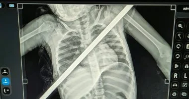 سيخ حديدي يعبر صدر طفلة من اليمين إلى اليسار.. والأطباء ينجحون في إنقاذها
