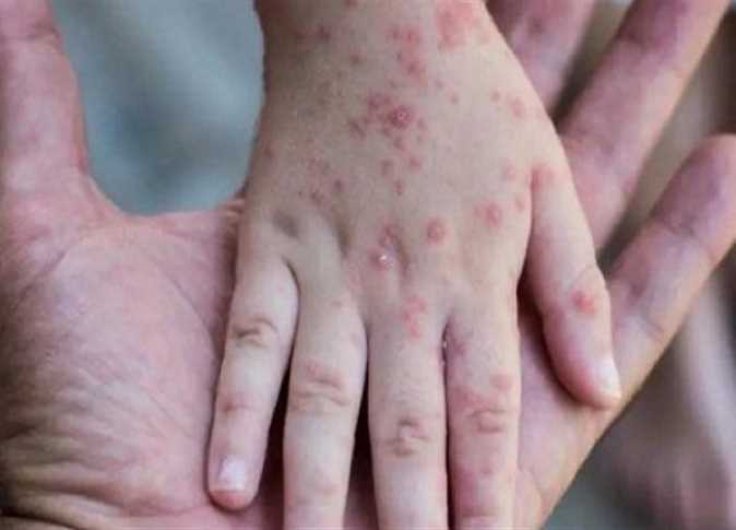 الصحة العالمية تحذر من استمرار تفشي جدري القرود